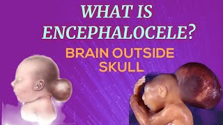 What is encephalocele [upl. by Anisamot113]