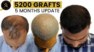 Grade 6 Hair Transplant Result  5000 Grafts Hair Transplant [upl. by Arretahs]