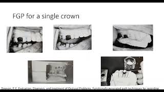 Fixed Partial Denture Part II Functionally generated path by Dr Rahul Jaiswal Guided by Dr Mahan [upl. by Beauregard]