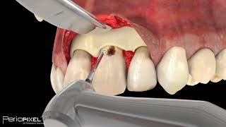 Avance vídeo completo quotCaries Subgingivalquot  PerioPixel [upl. by Spohr]