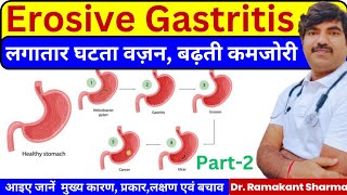 Understanding Erosive Gastritis Causes Symptoms and Management Strategiesdrramakantsharma7 [upl. by Dnalram]