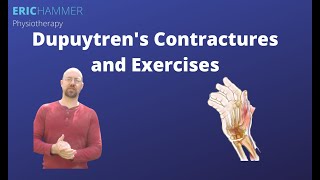 Dupuytrens Contractures and Exercises [upl. by Zaneta740]