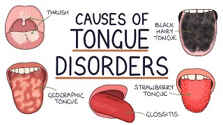 Understanding Tongue Disorders Causes and Management [upl. by Taber]