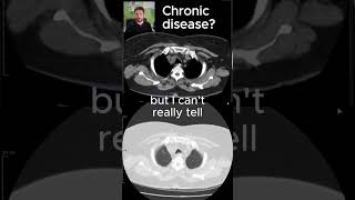 Are you sure this is COPD  CT SCANS Ep 18 medicalimaging copd ctscan pneumonia [upl. by Airamas]