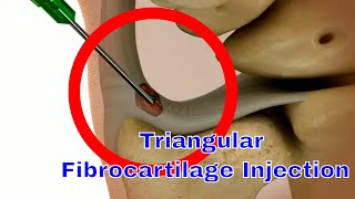 Triangular Fibrocartilage Complex TFCC Injection Technique A StepbyStep Guide [upl. by Suilmann]