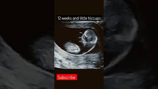 Baby kicking in mothers womb hiccups baby pregancyultrasound babyboy ultrasoundpics [upl. by Skippie]