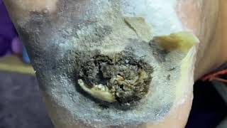 Pedicure video15，largeblack plantar wart [upl. by Aniroz]