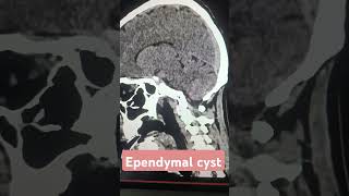 ctscan radiological radiology cyst brain diagnosticradiology phonk halloween beats [upl. by Marlyn773]