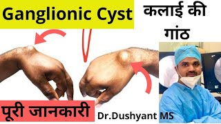 Ganglion Cyst क्या होता है कलाई की गांठ का BEST इलाज How to treat Ganglion Cyst DrDushyant [upl. by Ledeen]