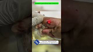 Pyogenic granuloma laser treatment  red bump on sole  pyogenic granuloma का इलाज़ Dr Uttam Lenka [upl. by Norma]