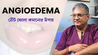 quotAngioedema Explained in Bengali  এনজিওডিমাquot [upl. by Thebazile648]