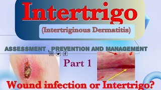 IntertrigoIntertriginous Dermatitis Assessment  Prevention and Management [upl. by Nesila]