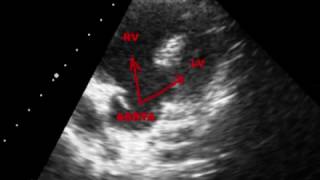 TETRALOGY OF FALLOT TOF  ECHOCARDIOGRAPHY SERIES BY DR ANKUR K CHAUDHARI [upl. by Kcireddor185]