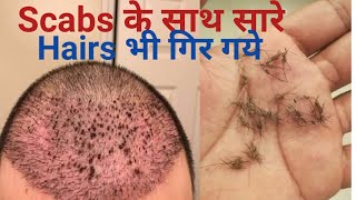 Hair Transplant  hair transplant cost in india  How to remove scabs after hair transplant [upl. by Ydnac]