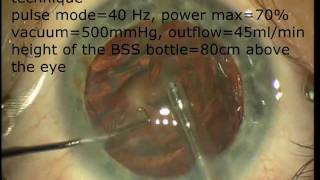 Multifocal lens in cataract surgery [upl. by Ahsercel]