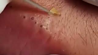 The Most Painful Blackhead Removal Video on Lips 2024 [upl. by Ahsilam70]