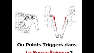 Tendinite de lépaule ou points trigger [upl. by Atilem]