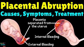 Placental Abruption Causes Symptoms Diagnosis Treatment Complications amp Prevention [upl. by Swane340]