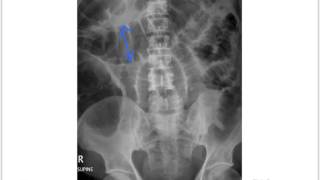 Small bowel obstruction [upl. by Myrwyn]