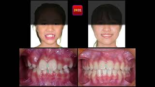 Molar Ankylosis｜【Chris Chang Ortho】CC796 [upl. by Ikiv]