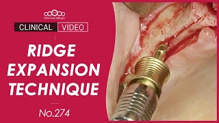 Ridge expansion with simultaneous implant placement Dr Jeon Inseong [upl. by Llorrac955]