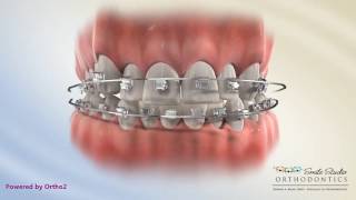 Damon Posterior Crossbite   Orthodontic Treatment [upl. by Abraham]