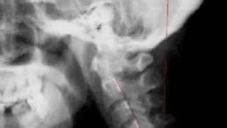 Upper Cervical Spinal Corrections Curvature Changes [upl. by Aizti830]