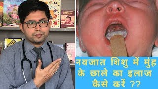 Oral candidiasis  Oral white patch  How to manage Oral thrush in baby  how to clean baby mouth [upl. by Enelear682]