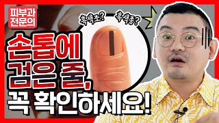 손톱에 검은줄이 피부암일수도 이 방법으로 즉시 감별해보세요 흑색조 감별법 [upl. by Vargas]