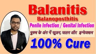 Balanitis  How to Cure Balanitis  पुरुष के अंग में सूजन जलन और इन्फेक्शन का इलाज [upl. by Kcam]