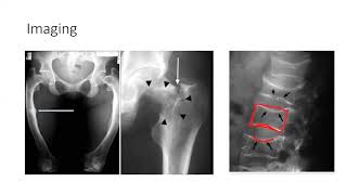 Osteomalacia and Rickets [upl. by Sices90]