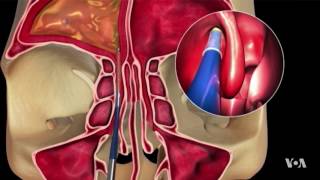 NonInvasive Procedure Is Proving Successful in Sinusitis Treatment [upl. by Ahseyn]