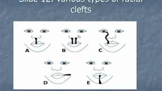 Slide 12 Various types of facial clefts [upl. by Comfort]