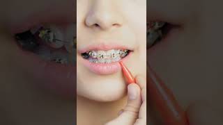 Braces cleaning appliance dentalcare dentalhygiene dentalhealth orthodontics [upl. by Snyder]