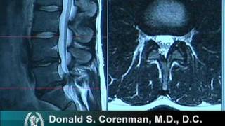 How to Read a MRI of a Lumbar Herniated Disc  Lower Back Pain  Colorado Spine Surgeon [upl. by Caiaphas]