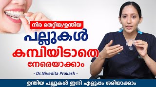 ഉന്തിയ പല്ലുകൾ ഇനി എളുപ്പം നേരയാകാം കമ്പിയിടാതെ  Clear Aligners for Teeth  Elite Dental Studio [upl. by Nij712]