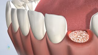 Why are bone grafting after extractions necessary [upl. by Muire]