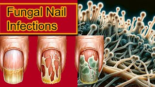 Understanding Onychomycosis Nail Fungal Infection Treatment [upl. by Faus]