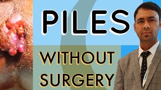 PILES TREATMENT  WITHOUT SURGERY [upl. by Hnilym]