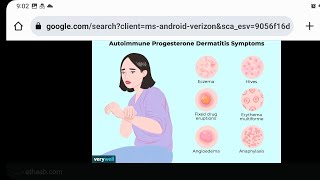 Autoimmune progesterone dermatitis in mystery diagnosis [upl. by Arondel]