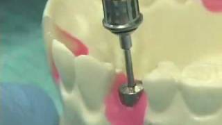 Placing Implant Abutments [upl. by Alyosha]