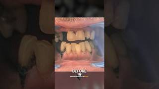 Perfect SnapOn Veneers A Brighter Image Lab Review [upl. by Kesia935]