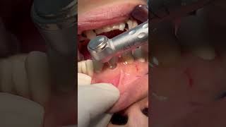 Cleaning deep tooth caries dental [upl. by Gilburt537]