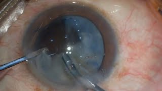 Posterior capsular tear at the start of Phaco what to do [upl. by Arabeila735]