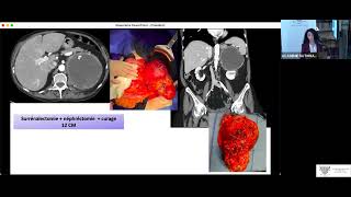 02 Surrénalectomie robotique [upl. by Nomyt]