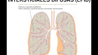 FISIOPATOLOGÍA RESPIRATORIA Enfermedades pulmonares intersticiales difusas EPID [upl. by Nerat950]