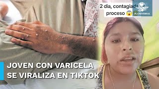 Joven se viraliza tras confundir viruela del mono con varicela [upl. by Ahsino]