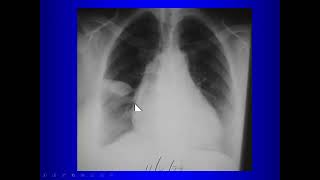 Abnormalities on Thoracic Radiography for Medical Students [upl. by Etnuhs390]