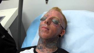 Incredible Face Tattoo Removal  3rd Treatment at Dr Tattoff [upl. by Eniowtna]