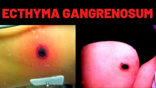 WHAT IS ECTHYMA GANGRENOSUM Causes Symptoms [upl. by Akinehs]